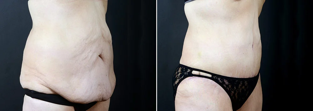 tummy-tuck-liposuction-2291b-sobel