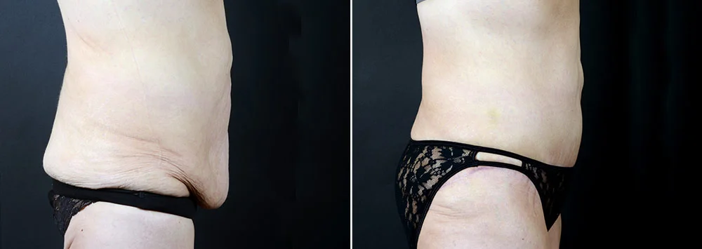 tummy-tuck-liposuction-2291c-sobel