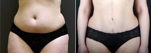 Tummy Tuck