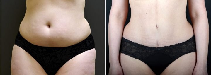 tummy-tuck-liposuction-2636a-sobel-