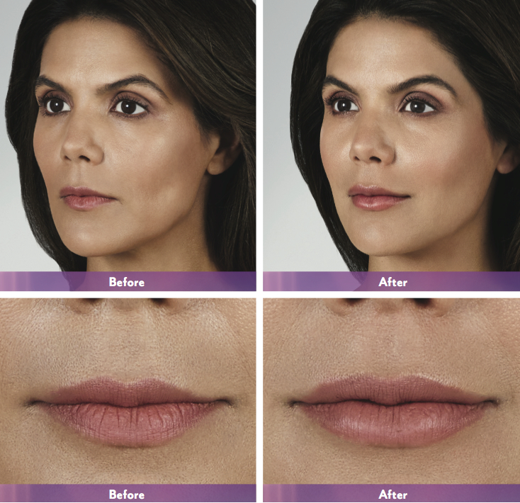 Before and after Volbella