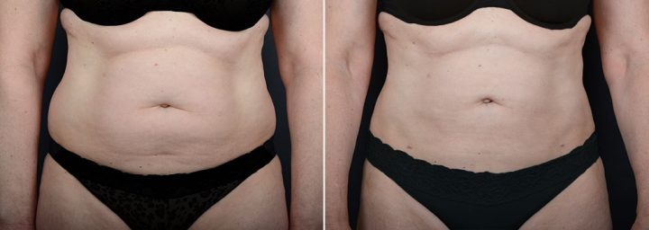 liposuction-8025a-sobel