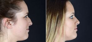 rhinoplasty-10035c-sobel