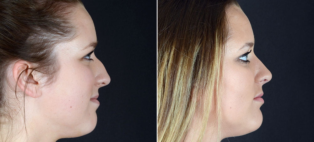 Before and after rhinoplasty surgery with Dr. Alex Sobel