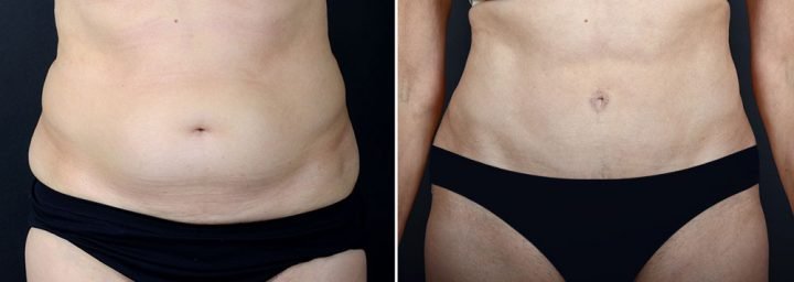 abdominoplasty-10229a-sobel