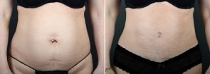 Tummy Tuck & Fat Transfer to Buttocks