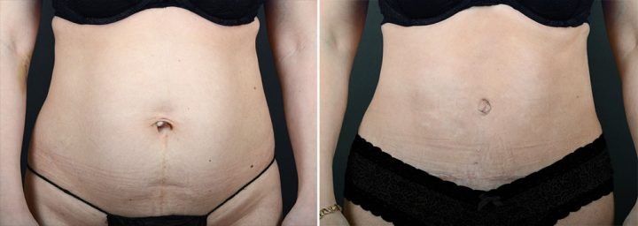 abdominoplasty-10320a-sobel