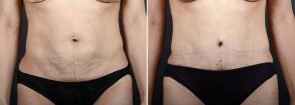 Tummy Tuck