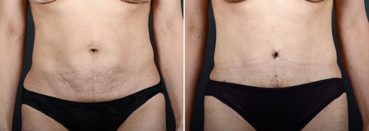 abdominoplasty-10342a-sobel