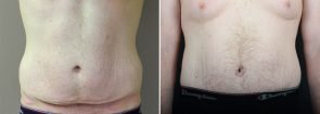 Tummy Tuck