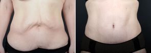 Tummy Tuck