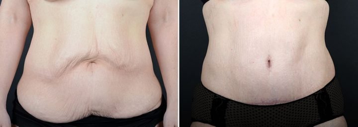 abdominoplasty-10490a-sobel