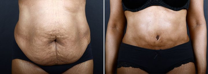 abdominoplasty-liposuction-10216a-sobel