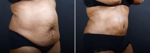 abdominoplasty-liposuction-10216b-sobel