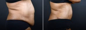 abdominoplasty-liposuction-10216c-sobel