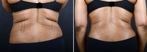 abdominoplasty-liposuction-10216d-sobel