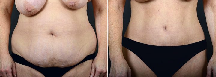 abdominoplasty-liposuction-10290a-sobel