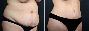 abdominoplasty-liposuction-10290b-sobel