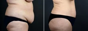 abdominoplasty-liposuction-10290c-sobel