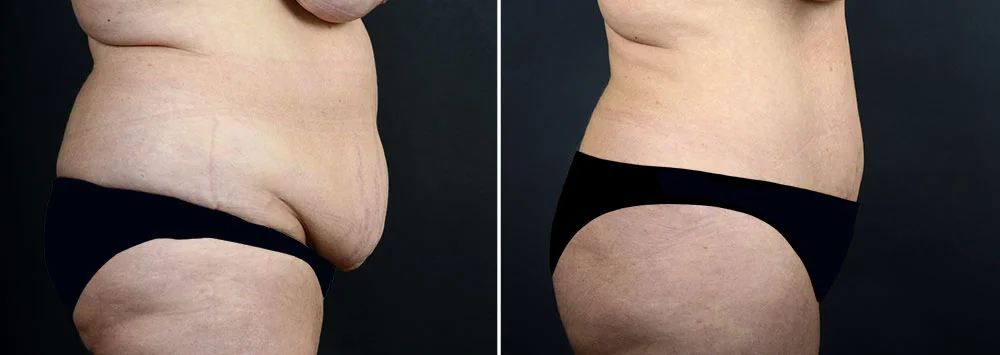 abdominoplasty-liposuction-10290c-sobel