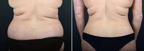 abdominoplasty-liposuction-10290d-sobel