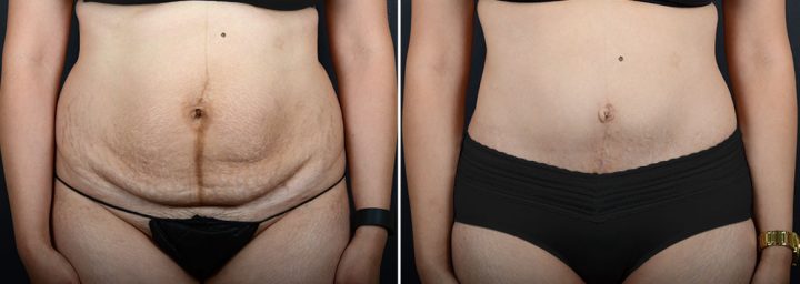 abdominoplasty-liposuction-10304a-sobel