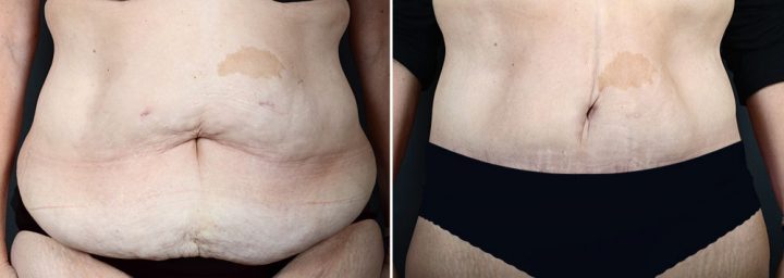 abdominoplasty-liposuction-10366a-sobel