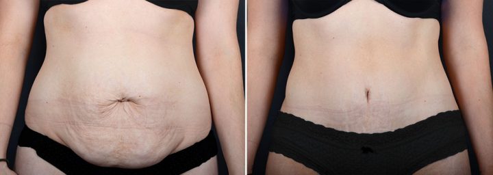 abdominoplasty-liposuction-10378a-sobel