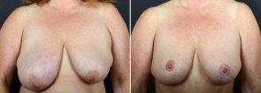 Breast Lift