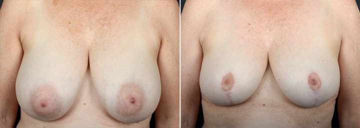 breast-reduction-10047a-sobel