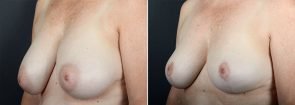 breast-reduction-10047b-sobel
