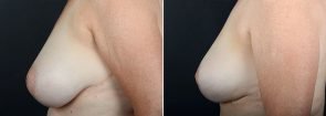 breast-reduction-10047c-sobel