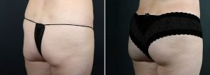 fat-transfer-buttocks-10320b-sobel