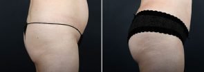 -fat-transfer-buttocks-10320c-sobel