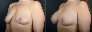 breast-augmentation-10865b-sobel