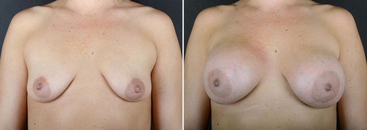 breast-augmentation-10876a-sobel