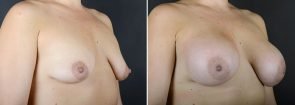 breast-augmentation-10876b-sobel