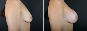 breast-augmentation-10876c-sobel