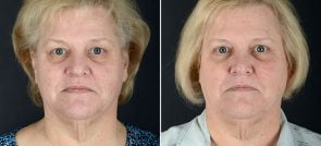 Eyelid Lift & Brow Lift