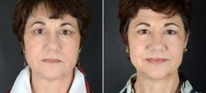 Eyelid Lift & Brow Lift