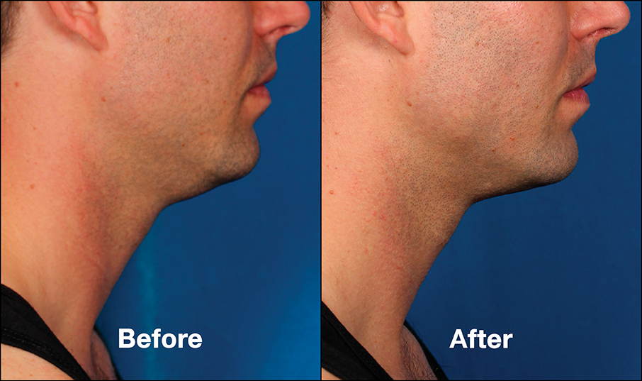 Before & after Kybella injections. Photos courtesy Allergan, inc.*