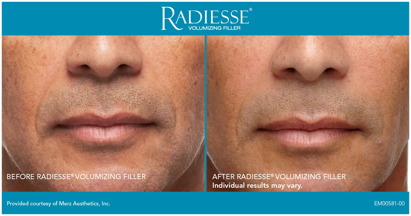 Before & after Radiesse to nasolabial folds. Photos courtesy Merz.*