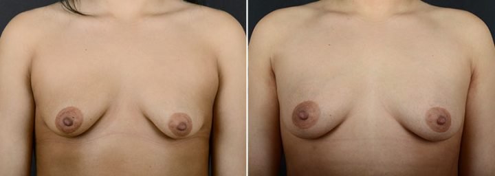 fat-transfer-breast-augmentation-11462a-sobel