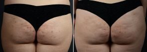 fat-transfer-buttocks-11361d-sobel