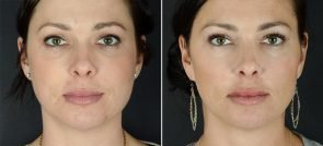 injectable-fillers-volbella-lips-11382a-sobel
