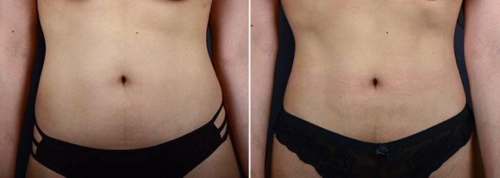 liposuction-abdomen-waist-hips-11347a-sobel