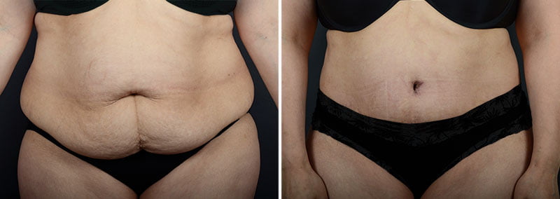 Before and after tummy tuck and liposuction