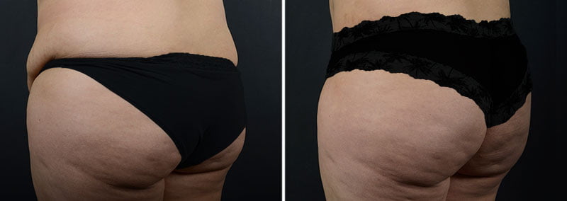 Before and after liposuction with fat transfer