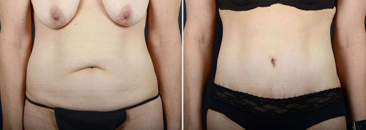 abdominoplasty-liposuction-11924a-sobel