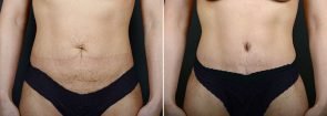 Tummy Tuck